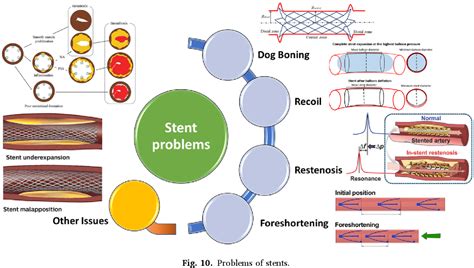 Evaluation of coronary stents: A review of types, materials, processing ...