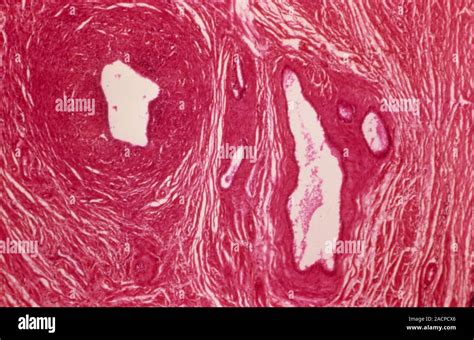 Inflamed Fallopian Tube Light Micrograph Of A Section Through A