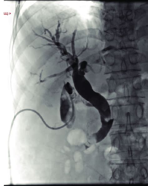 Cholangiogram Showing Gallstones And An Obstructing Lower Common Bile Download Scientific