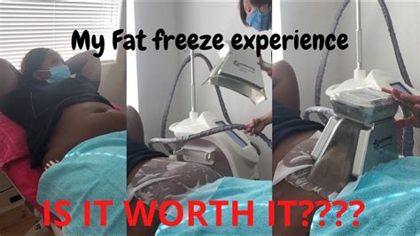 Fat Freeze Experience With The Fat Freeze Clinic Port Elizabeth Is It