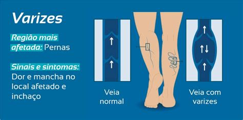 Doenças Vasculares Saiba Como Afetam Seu Corpo E Aprenda A Prevenir Se