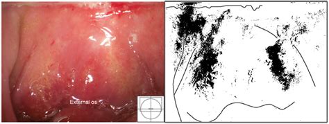 Grainy Sandy Patches And Mucosal Bleeding Grainy Sandy Patches On The