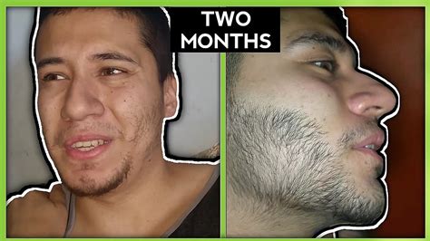 Minoxidil Beard Growth Real Before And After Photos 44 Off