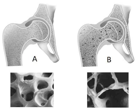 Bone In 2 Conditions Normal A Vs Osteoporotic B [9] Download Scientific Diagram