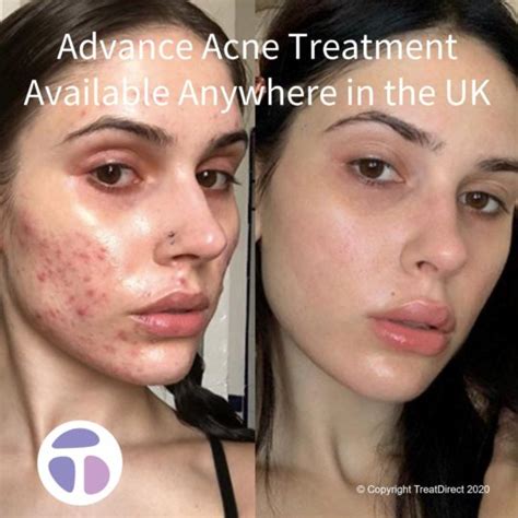 Acne Vulgaris Before And After