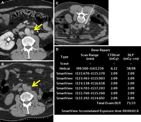 CT-guided biopsy of a para-aortic retroperitoneal lymph node (arrow)... | Download Scientific ...