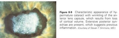 Lens Induced Glaucoma Flashcards Quizlet