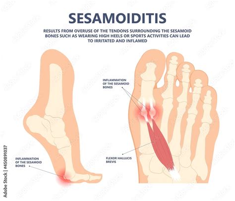 bone tendon joint inflamed foot big toe sport injury pain under ball ...