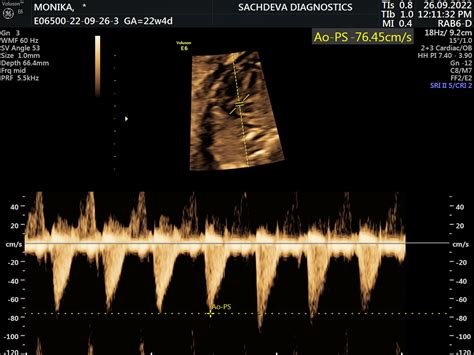 Color Doppler Sachdeva Diagnostics