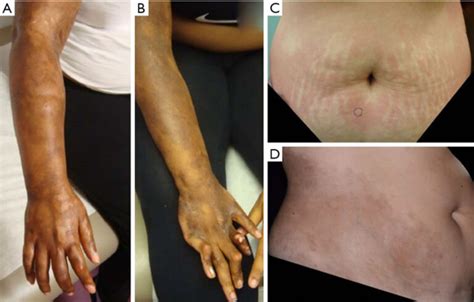 Morphea Skin Morphea Scleroderma Causes And Treatment