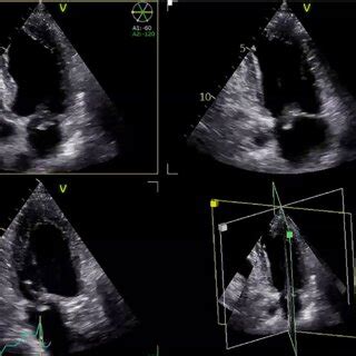 PDF Systemic Embolization In Infective Endocarditis