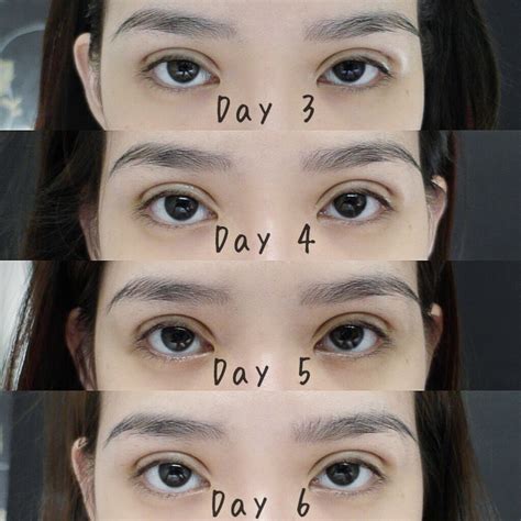 L I A N M E I T I N G My Double Eyelid Surgery Experience