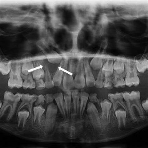 A Panoramic View Shows A Unicystic Ameloblastoma Presenting As A