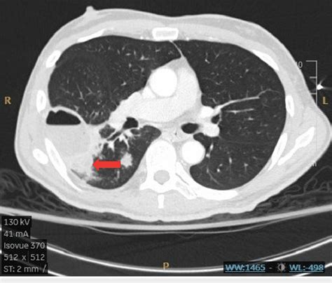 Axial Chest Ct Showing Complicated Abscess The Red Arrow Point To The