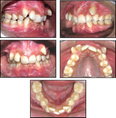 Class Ii Malocclusion