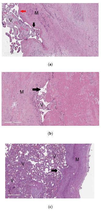 Histological Analysis Of The Placenta With Pathological Invasion Download Scientific Diagram