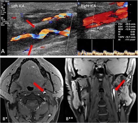 A Color Coded Duplex Sonography Of The Right And Left Internal Carotid