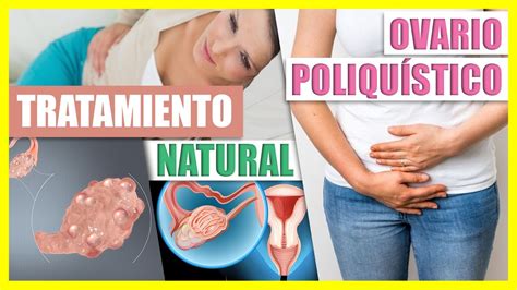 Como Curar El Síndrome De Ovario Poliquístico Remedios Naturales