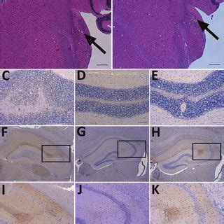 Vacuolation Profiles Of A Clinical Case Of Vcjd In A Prion Protein Gene