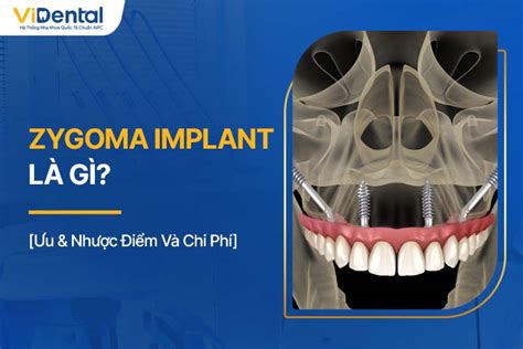 Zygoma Implant Là Gì Đối Tượng Ưu And Nhược Điểm Và Chi Phí