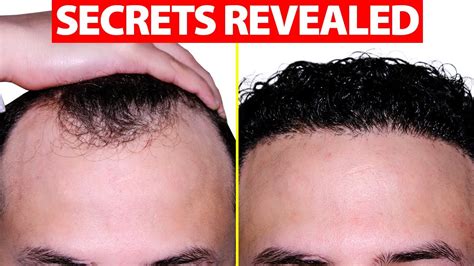 How To Fix Your Receding Hairline Youtube