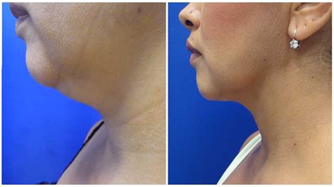 Chin Liposuction Milwaukee - Milwaukeeliposuction.com