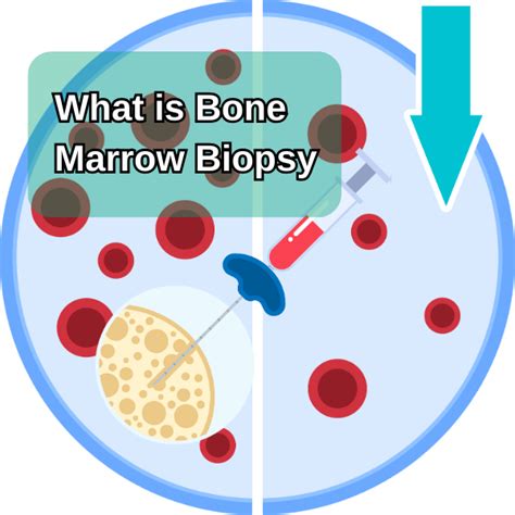 Bone Marrow Biopsy 101: Fun Masterclass for Surprises