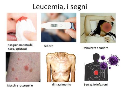 Leucemia Guida Completa Ai Diversi Tipi Sintomi E Cure Disponibili