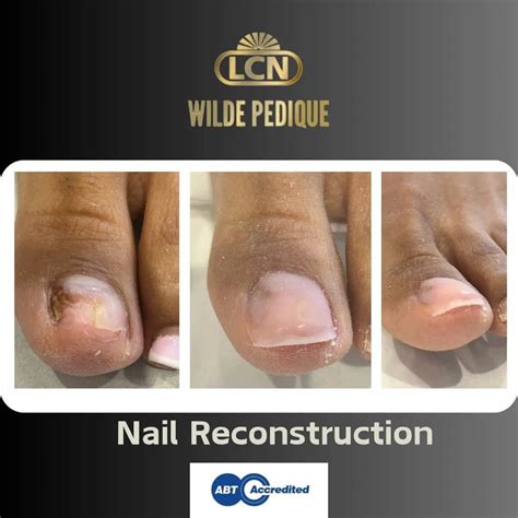 Wilde Pedique Silver Plus Toenail Reconstruction Easy Feet Podiatry