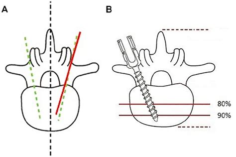 Pedicle Screw Position 17 Download Scientific Diagram