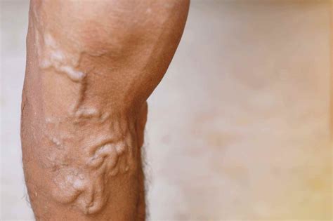 Varicose Veins Symptoms Treatment Vein Clinic Perth