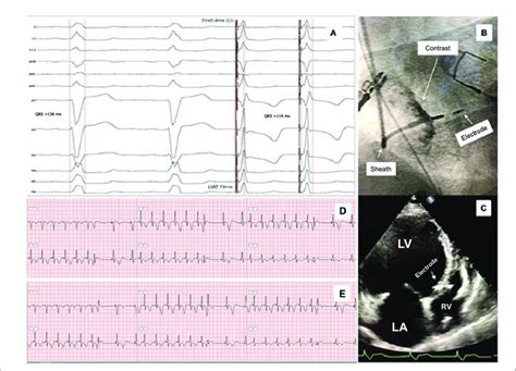 Extrastimuli Technique Through The Pacemaker Electrode To Show The