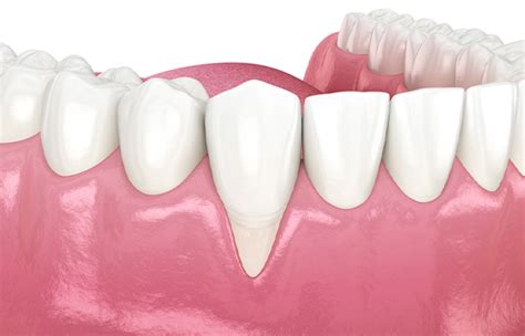 Services Austin Implants And Periodontics