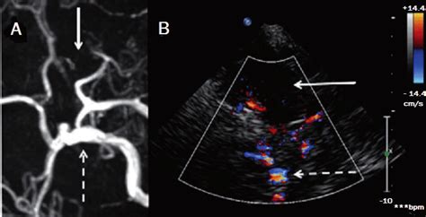 Right internal carotid artery (ICA) occlusion (A) on magnetic resonance... | Download Scientific ...