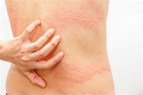 Hives (Urticaria) - Symptoms, Causes, Treatment and Photos