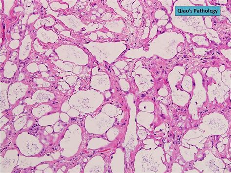 Qiaos Pathology Uterine Adenomatoid Tumor A Photo On Flickriver