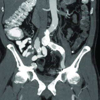 Computed Tomography CT Follow Up At 1 Month Demonstrating Resolution