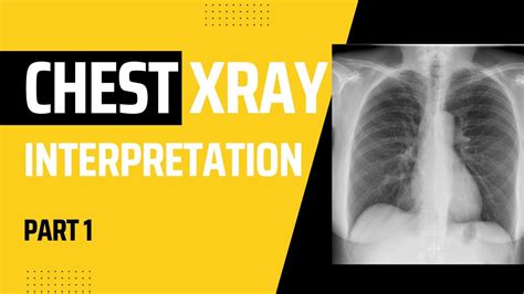 How To Read A Chest Xray A Step By Step Guide Youtube