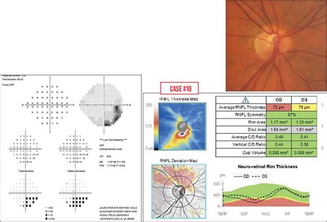 Nasal Visual Field Defect