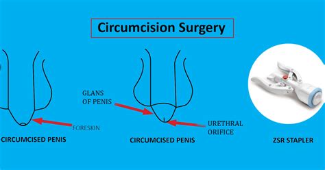 Top Laser Circumcision Surgery In Hyderabad Amista Hospitals