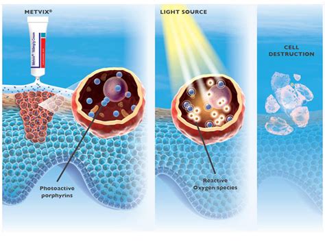 Photodynamische Therapie PDT Bei JUVENIS Wien