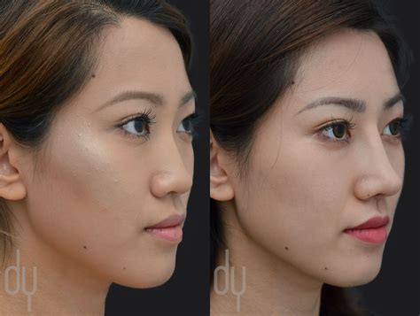 Nose Job Before And After Asian Before And After