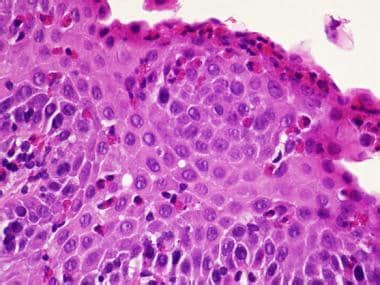 Eosinophilic Esophagitis Rings