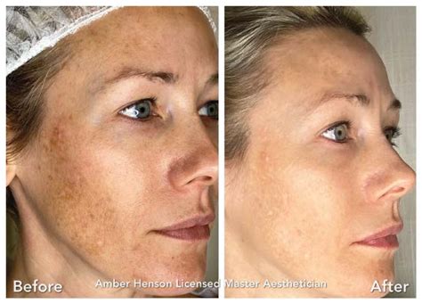 Melasma Treatment Nyc Lasers Microneedling Skin Care