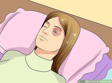 3 Ways to Treat a Black Eye - wikiHow