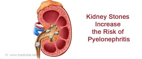 Pyelonephritis Causes Symptoms Diagnosis Treatment And Prevention