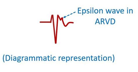 Epsilon Wave – All About Cardiovascular System and Disorders