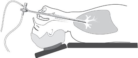 [PDF] Anesthesia for adult rigid bronchoscopy. | Semantic Scholar