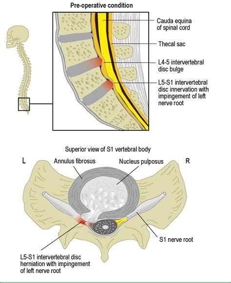 cauda equina syndrome surgery