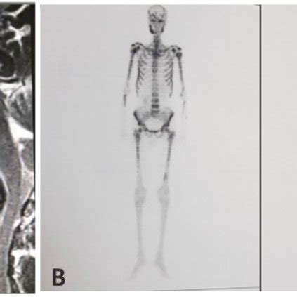 A Orbital T2 Sagittal Image Shows Abnormal Bone Marrow Signal And